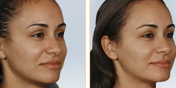 Sculptra B_A One At H-Town Aesthetics In Katy, TX