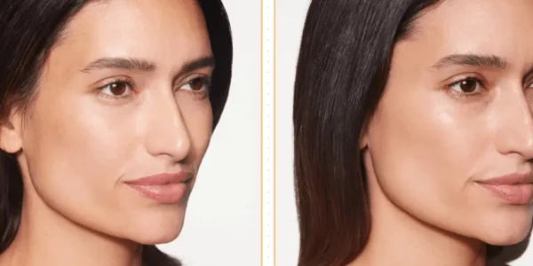 Sculptra B_A Three At H-Town Aesthetics In Katy, TX