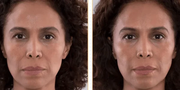 Sculptra B_A Two At H-Town Aesthetics In Katy, TX