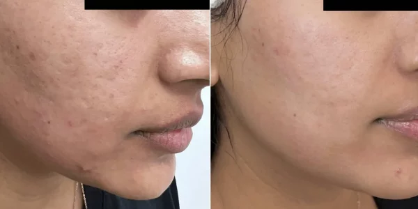 Secret RF Microneedling B_A Five At H-Town Aesthetics In Katy, TX
