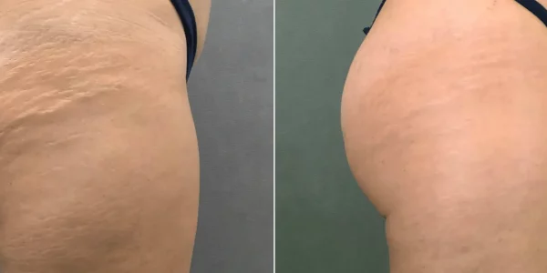 Secret RF Microneedling B_A Four At H-Town Aesthetics In Katy, TX