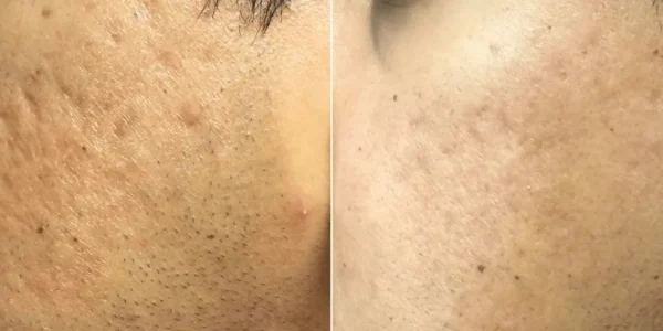 Secret RF Microneedling B_A One At H-Town Aesthetics In Katy, TX