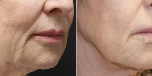 Secret RF Microneedling B_A Three At H-Town Aesthetics In Katy, TX