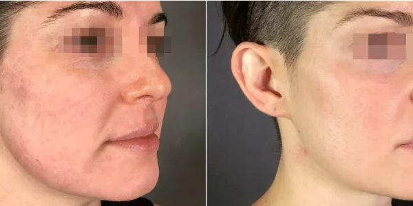 Secret RF Microneedling B_A Two At H-Town Aesthetics In Katy, TX