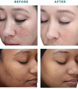 Vi Chemical Peels B_A Five At H-Town Aesthetics In Katy, TX