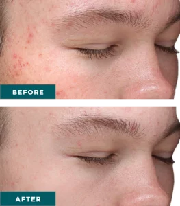 Vi Chemical Peels B_A Four At H-Town Aesthetics In Katy, TX