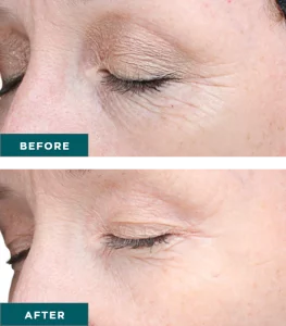 Vi Chemical Peels B_A One At H-Town Aesthetics In Katy, TX