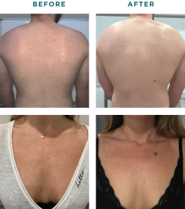 Vi Chemical Peels B_A Six At H-Town Aesthetics In Katy, TX