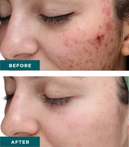 Vi Chemical Peels B_A Three At H-Town Aesthetics In Katy, TX