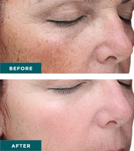Vi Chemical Peels B_A Two At H-Town Aesthetics In Katy, TX